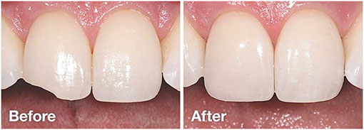 cosmetic-bonding-before-after